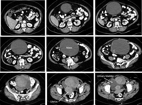 Twisted Gangrenous Ovarian Mucinous Cystadenoma Radiology Cases