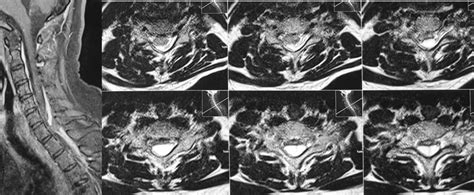 T Sagittal And Axial Images Of Mri Of Cervico Dorsal Spine Shows E P I