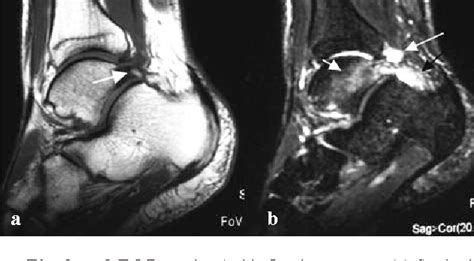 Figure 3 From Posterior Ankle Impingement Syndrome A Clinical Review