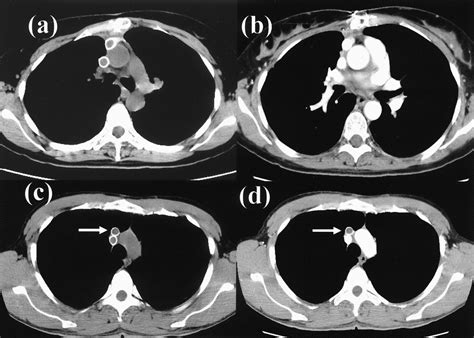 Long Term Graft Patency After Replacement Of The Brachiocephalic Veins