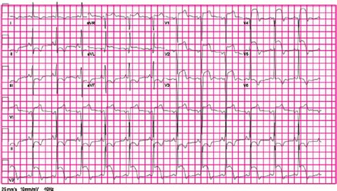 Twelve Lead Electrocardiogram Demonstrating Sinus Rhythm St Segment