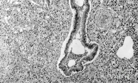 Pneumonia Alba In Congenital Syphilis by Science Source