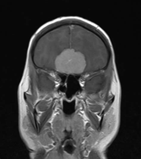 Olfactory Groove Meningioma Image