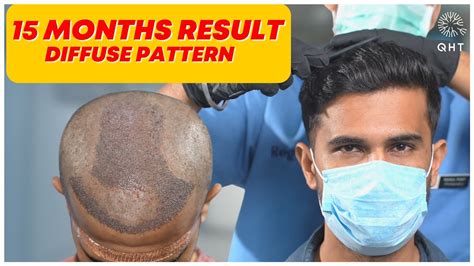 FUE Hair Transplant Results QHT FUE Hair Transplant Results Diffuse