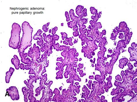 American Urological Association Nephrogenic Adenoma