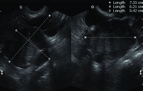 Pelvis Ultrasound With Left Adnexal Mass With Echogenic Solid Component Download Scientific