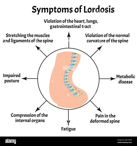 Symptoms of lordosis. Spinal curvature, kyphosis, lordosis, scoliosis ...