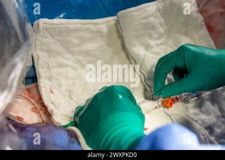 Proceso De Colocaci N De Stent De Coraz N En Sala De Operaciones