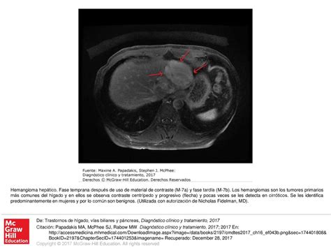 Hemangioma Hep Tico Fase Temprana Despu S De Uso De Material De