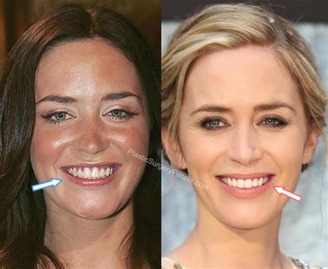 Did Emily Blunt Have Plastic Surgery? (Before & After 2022)