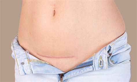 Top Treatments To Fade Surgical Scars London Premier Laser And Skin Clinic