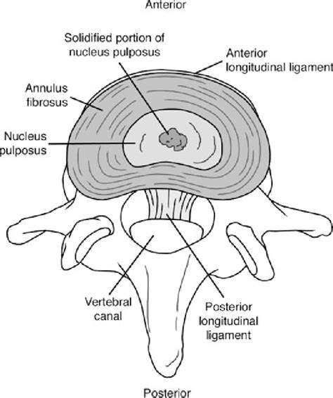 Intervertebral Disc Anatomy Physiology Pathophysiology Treatment