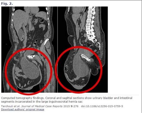 GRAPHIC IMAGES: Man’s giant hernia causes scrotum to swell larger than a football – Metro