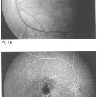 Af Images In Three Patients With Rod Cone Dystrophy And Normal Visual