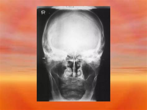 Extra Oral Radiology Techniques Ii Ppt