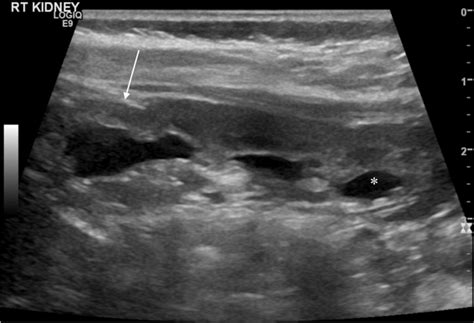 A Longitudinal B Mode Ultrasound 6 Months After Pyeloplasty In The Same Download Scientific