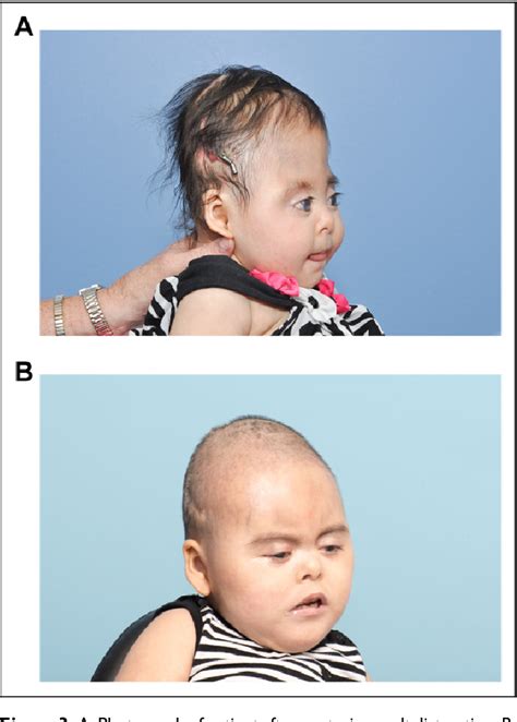 Figure 3 From Syndromic Multisuture Craniosynostosis With Associated