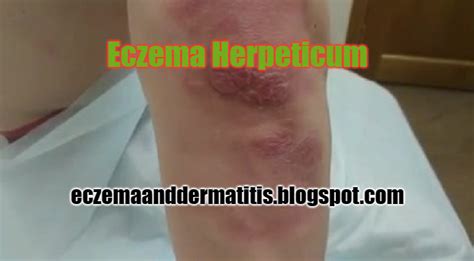 Eczema Herpeticum - Eczema and Dermatitis