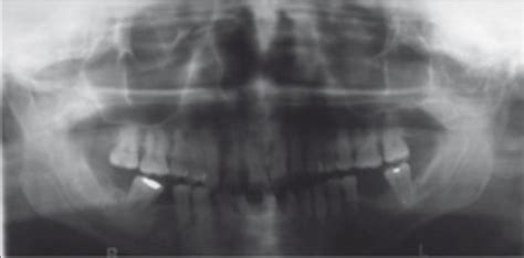 Opg Showing Hypercementosis In 14 And 15 Regions Download Scientific