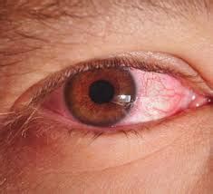 Kinds of eye infections symptoms complications and ways to prevent them