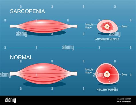 Sarcopenia Age Related Muscle Atrophy Comparison And Difference