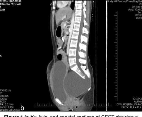 Figure 1 From Adult Anterior Sacral Meningocele Misdiagnosing As