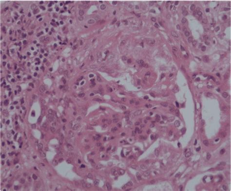 Crescentic Iga Nephropathy Following Bone Fracture