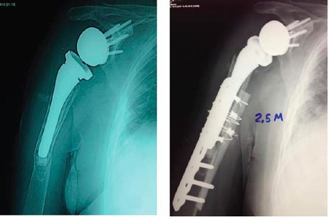 UW Shoulder and Elbow Academy: Complications of reverse total shoulder arthroplasty