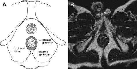 Magnetic Resonance Imaging Of Perianal Fistulas Magnetic Resonance