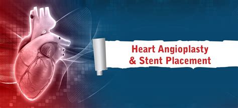 Cardiac Cath With Stent Placement