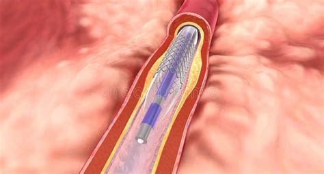 The Expanded Stent Restores Blood Flow And Will Remain In The Artery