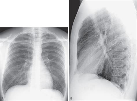 Normal Chest X Ray Images