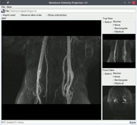 Starting Maximum Intensity Projection Mip