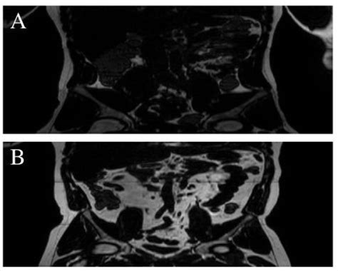 Imaging In Inflammatory Bowel Disease Current And Future Perspectives