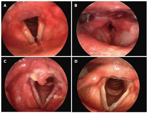 Laryngopharyngeal Reflux And Helicobacter Pylori