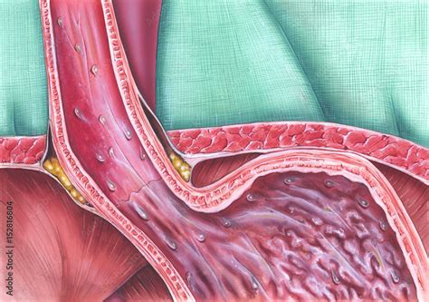 Gastroesophageal Reflux Disease GERD Caused When The Lower