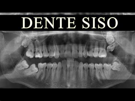 Quais os cuidados após a cirurgia de extração dos dentes sisos