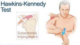 Hawkins Kennedy Test SAMARPAN PHYSIOTHERAPY CLINIC AHMEDABAD