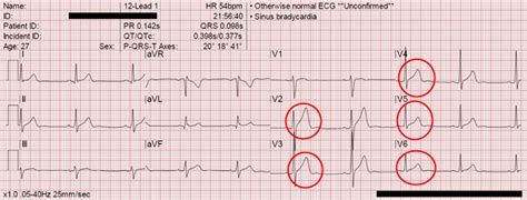 Syndrom Asn Repolarizace Ekg Medic Na Nemoci Studium Na Lf Uk