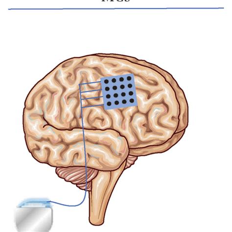 Neurostimulation Techniques For Chronic Pain Management Dbs Deep