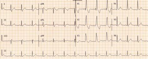 Wide Complex Tachycardia Differential Diagnosis Wikidoc