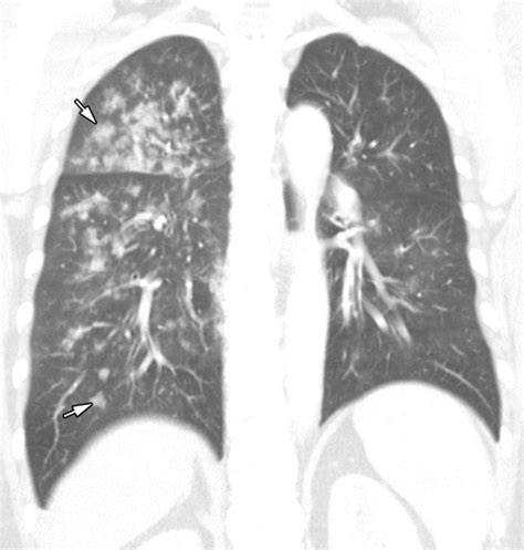 Radiographic And CT Features Of Viral Pneumonia RadioGraphics