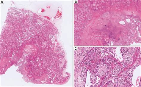 Histological Findings Of The Placenta A Overview Of A Basally