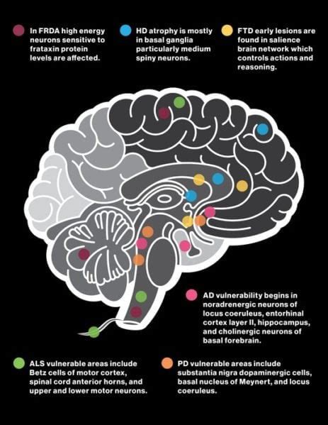 Common Features Among Neurodegenerative Diseases Opening Door To Early