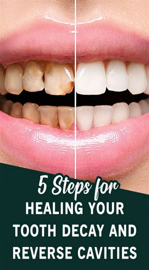 How To Reverse Tooth Decay On Front Teeth