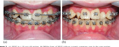 Mild Gingivitis With Braces