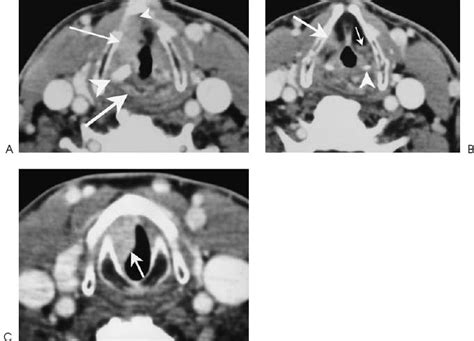 Squamous Cell Carcinoma Of The True Vocal Cord Glottis Radiology Key