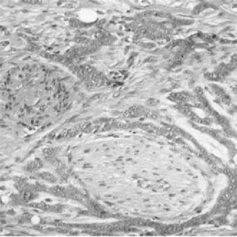 Recurrent Basal Cell Carcinoma In Subcutaneous Tissue With Involvement