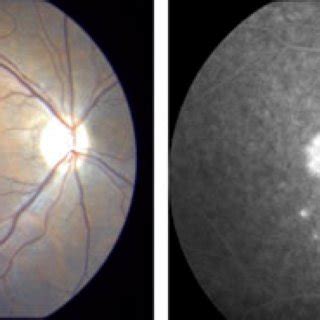 Right Fundus Photography And Fluorescein Angiography At Weeks Showing