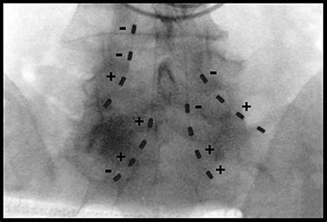 Transforaminal Nerve Root Stimulation A Technical Report Neuromodulation